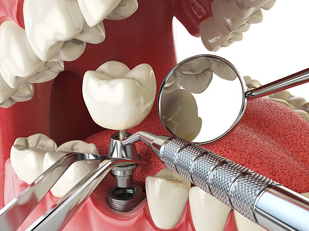 Best Emergency Root Canal Treatment in Fraser, CO